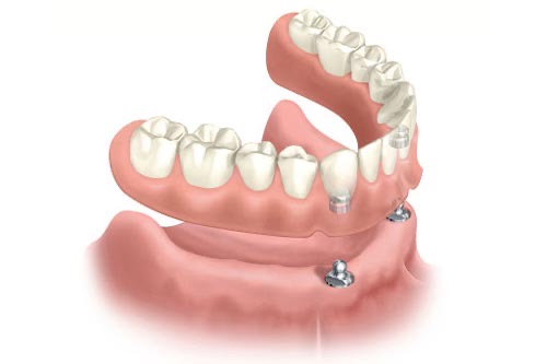 Snap-In Denture